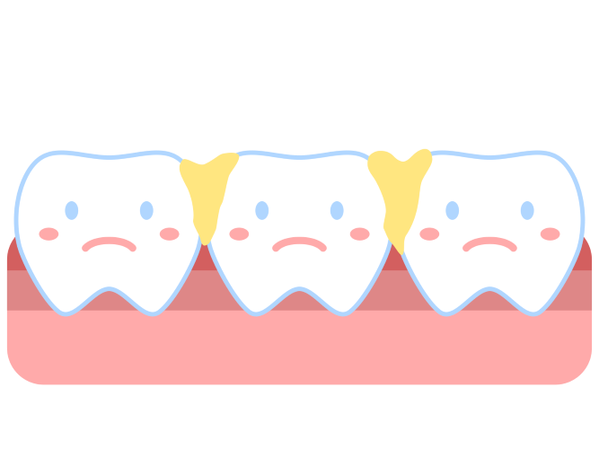 歯と歯の間の歯石
